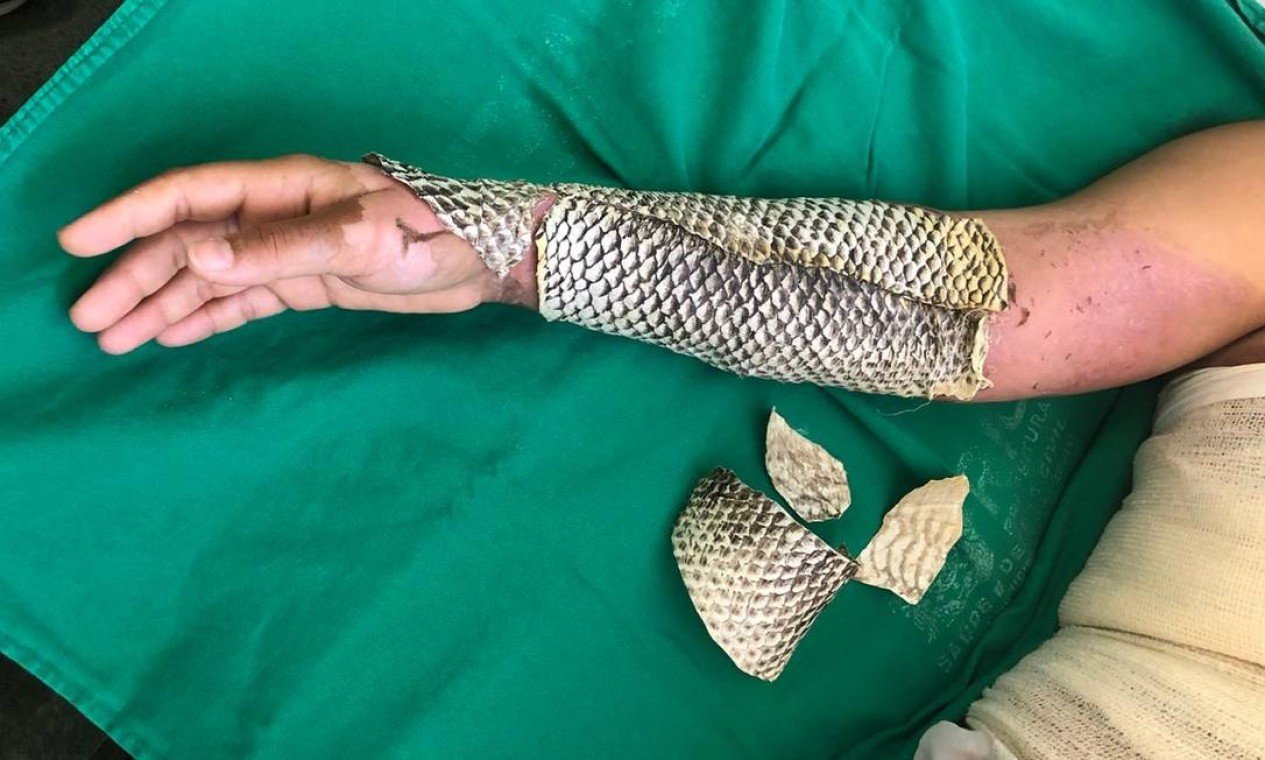 🐟🔥 DO CEARÁ PARA O MUNDO: PELE DE TILÁPIA VIRA CURATIVO PARA QUEIMADURAS