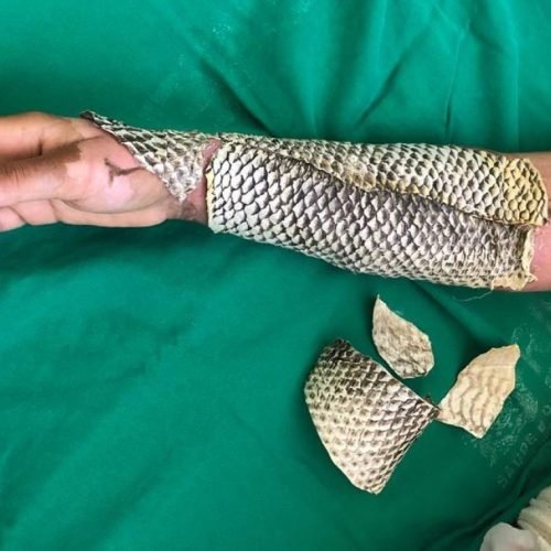 🐟🔥 DO CEARÁ PARA O MUNDO: PELE DE TILÁPIA VIRA CURATIVO PARA QUEIMADURAS