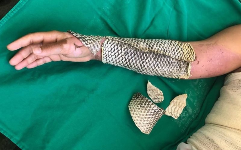 🐟🔥 DO CEARÁ PARA O MUNDO: PELE DE TILÁPIA VIRA CURATIVO PARA QUEIMADURAS